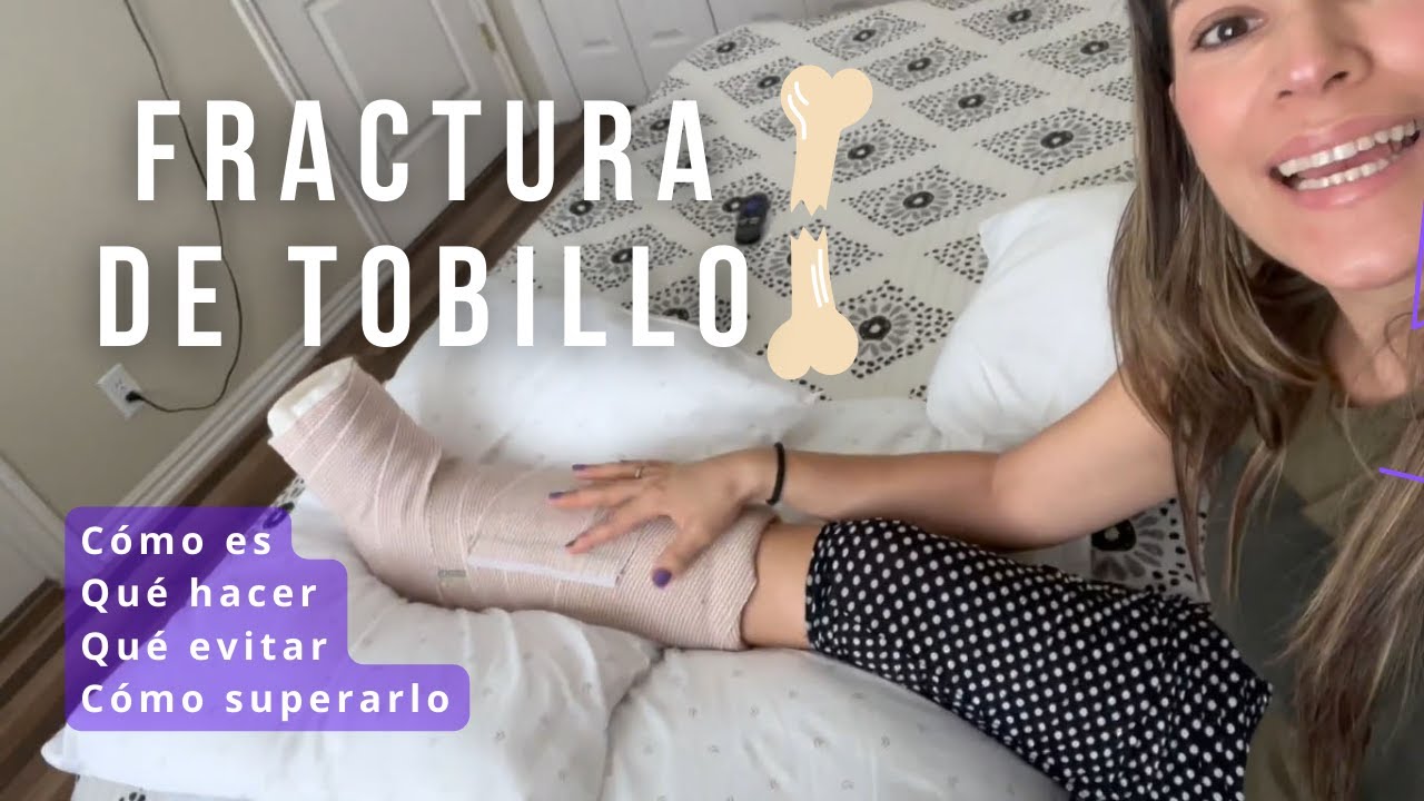 FRACTURA DE TOBILLO, TIENES QUE VER ESTO | Isabel Gómez