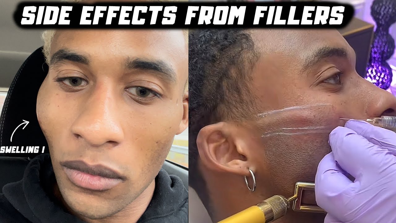 Why You&rsquo;re swollen after Cheek fillers, The Side Effects of Dermal Fillers | PrettyBoyfloyd 🌹