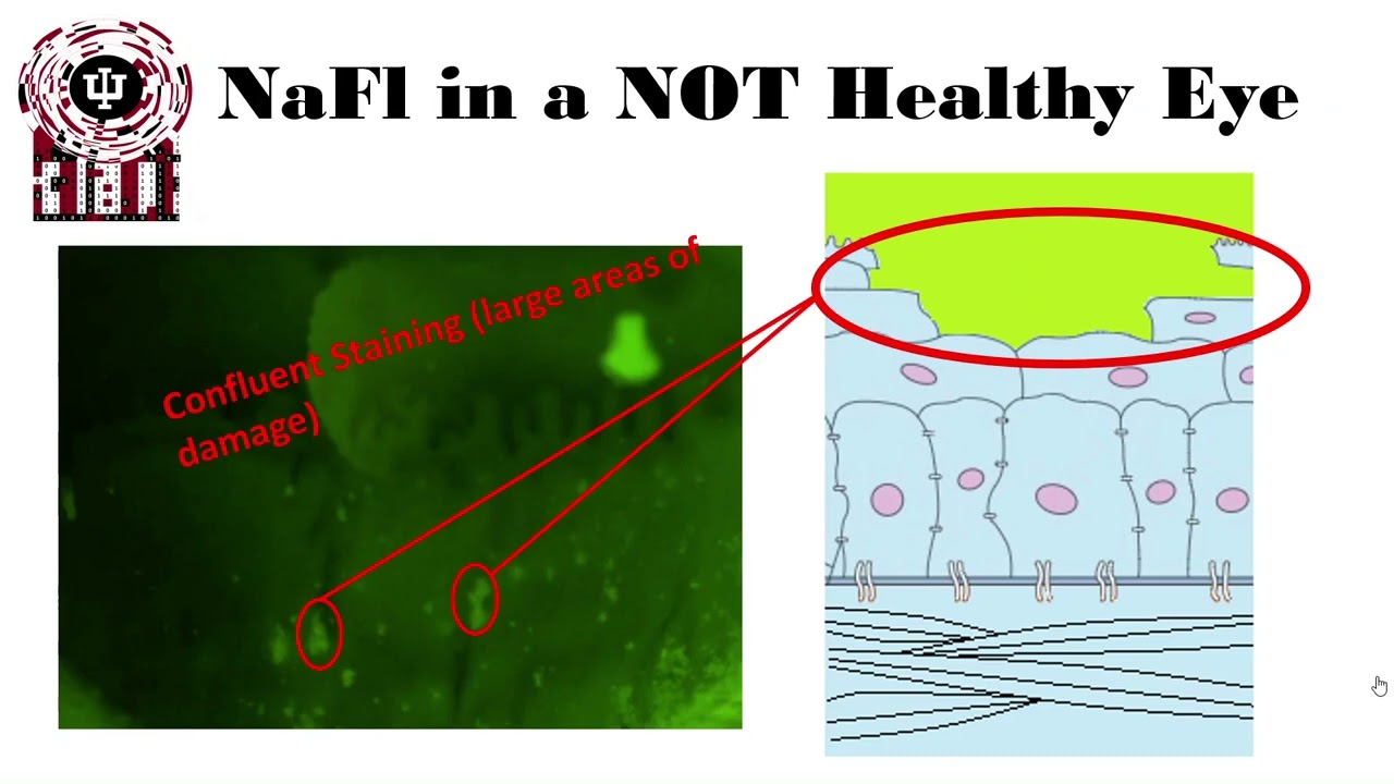 Sodium Fluorescein Dye and Staining in Eyecare Part I