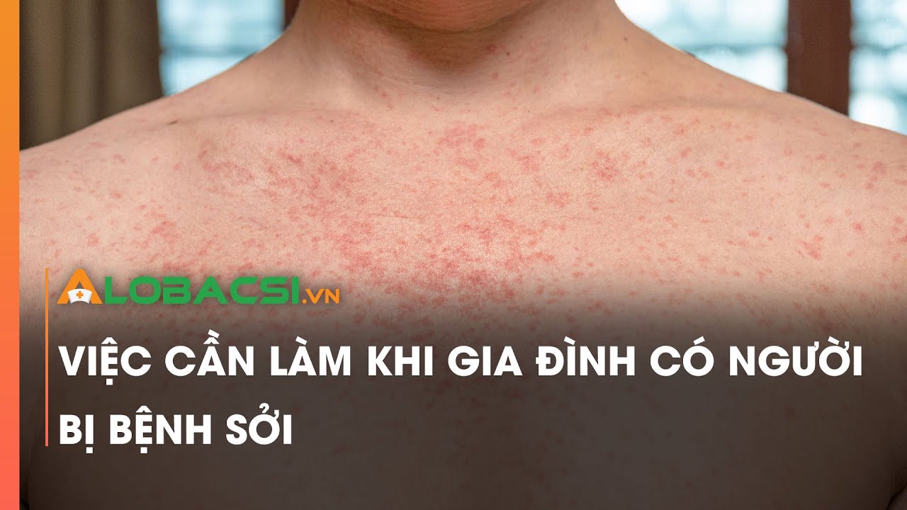Việc cần l&agrave;m khi gia đ&igrave;nh c&oacute; người bị bệnh sởi