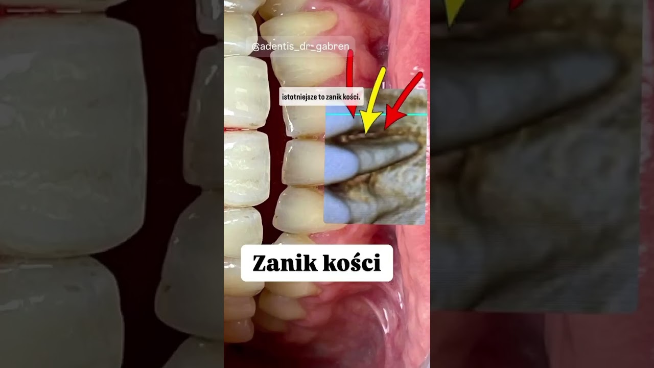 PARADONTOZA Po leczeniu Ortodontycznym. ZANIK KOŚCI - przeszczep dziąsła i kości #augmentacjakosci