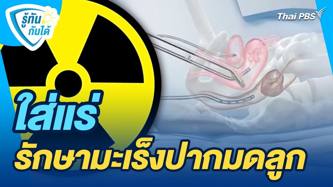 ใส่แร่ รักษามะเร็งปากมดลูก | รู้ทันกันได้ | วันใหม่วาไรตี้
