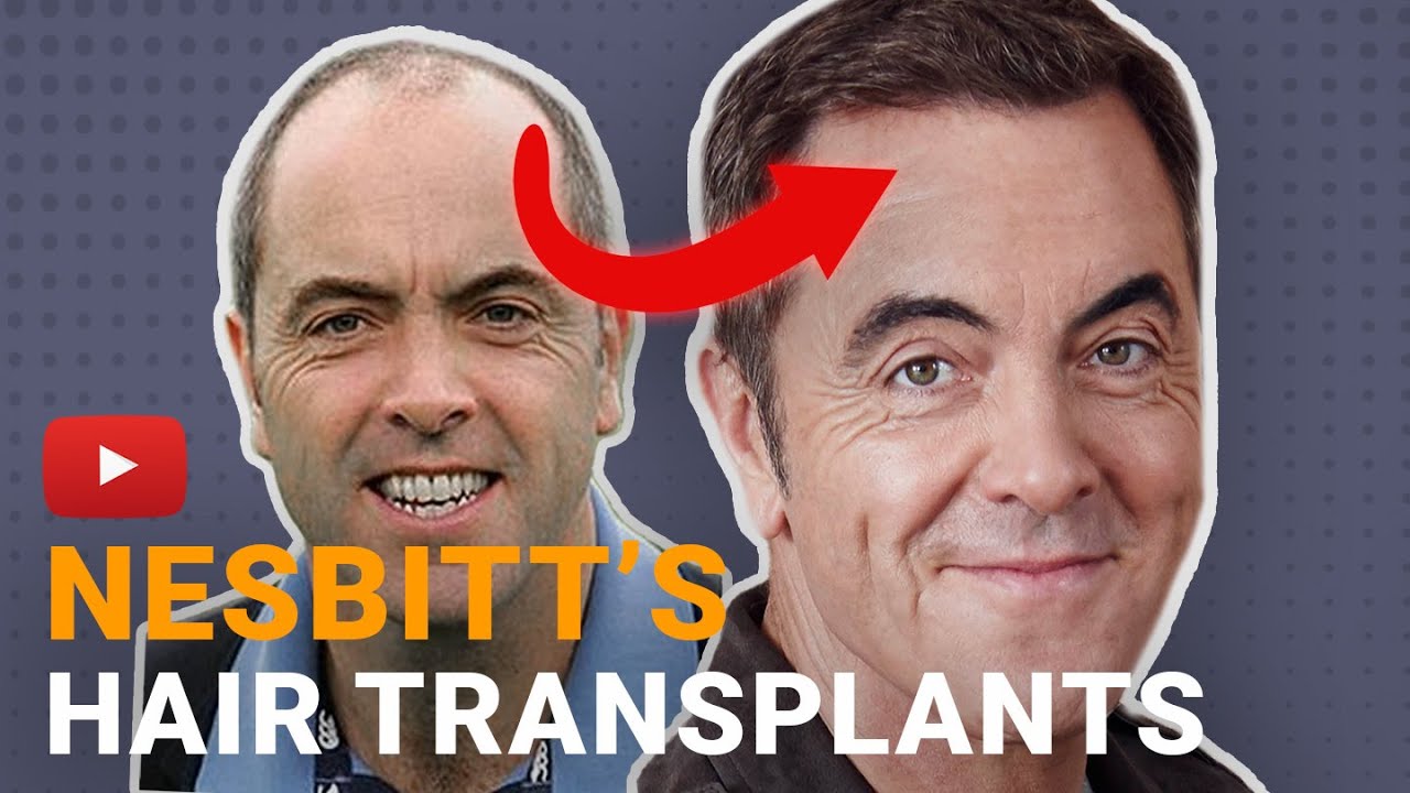 James Nesbitt's Hair Transplant - The Complete Story