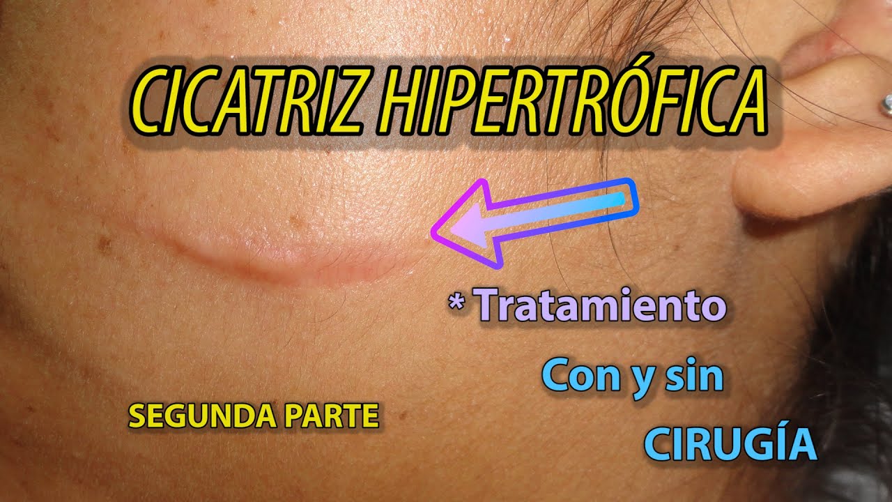 💥 CICATRIZ Hipertrófica | Cómo se trata?. PARTE 2 (FINAL).