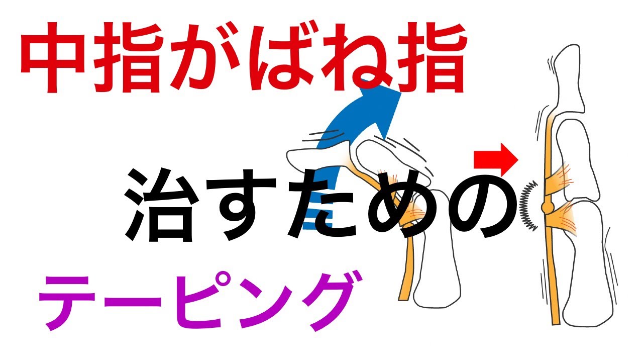 中指がばね指。痛みをひっかかりを改善するテーピング方法｜兵庫県西宮ひこばえ整骨院