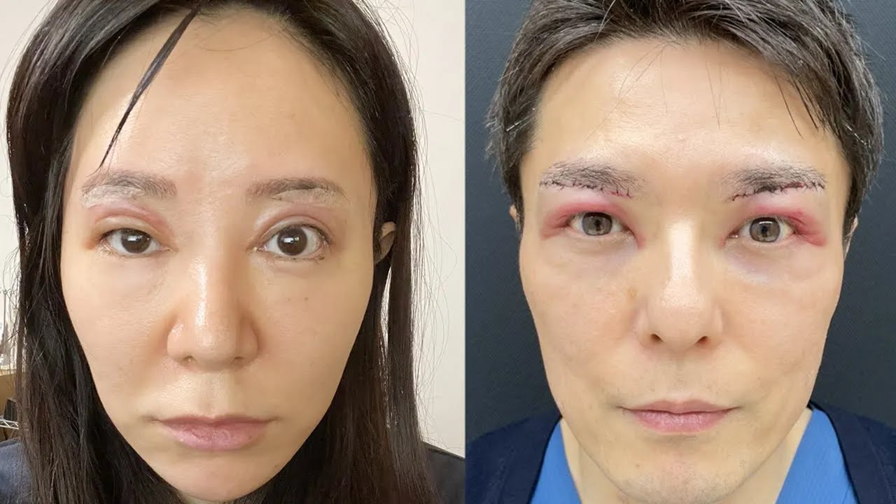 【眉下切開リフト】1年後 やっぱり傷跡は残った…？【週末うめこコラボ】