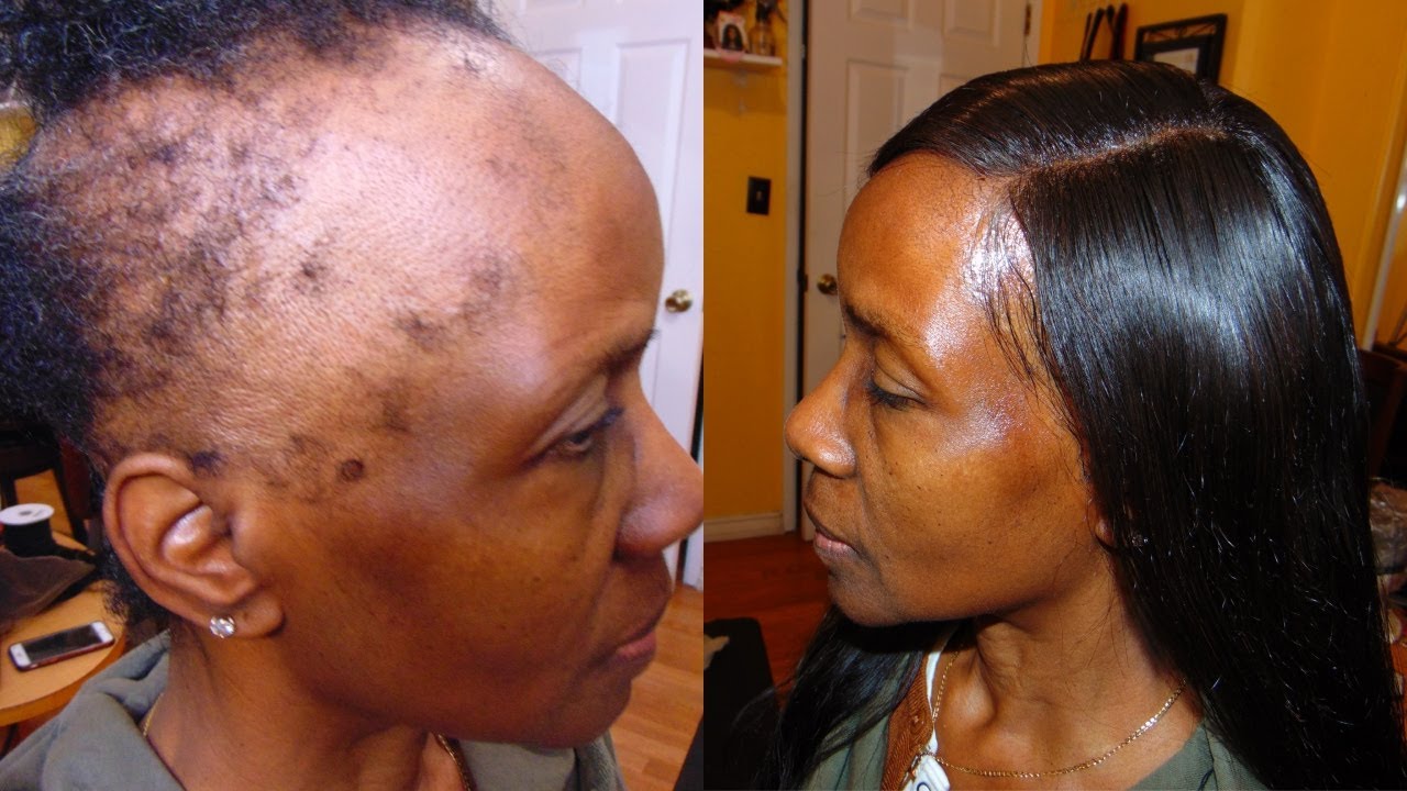 THE BEST HAIR WEAVE FOR ALOPECIA/HAIR LOSS/THIN/SHORT HAIR