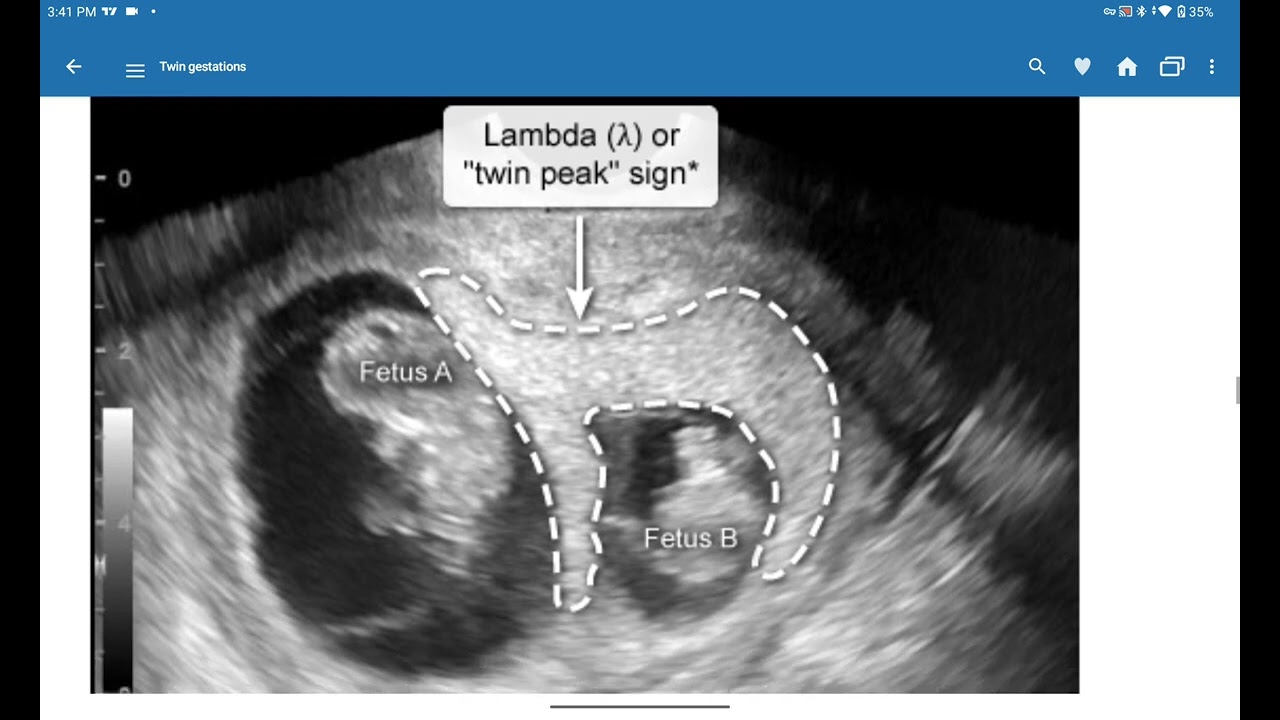 Twin Gestation