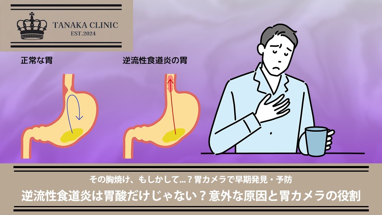 18　逆流性食道炎は胃酸だけじゃない？意外な原因と胃カメラの役割｜【胃腸と内視鏡の専門チャンネル】たなか内科クリニック