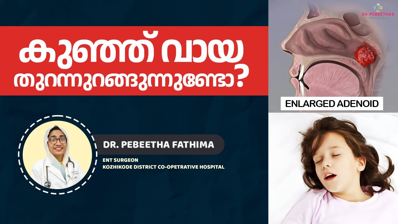 അഡിനോയ്ഡിനു ശസ്ത്രക്രിയ വേണോ? Adenoid Problem Explained.