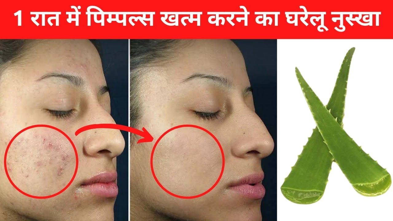 1 रात में पिम्पल्स खत्म करने का घरेलू नुस्खा | How To Remove Pimples Naturally With Aloe Vera
