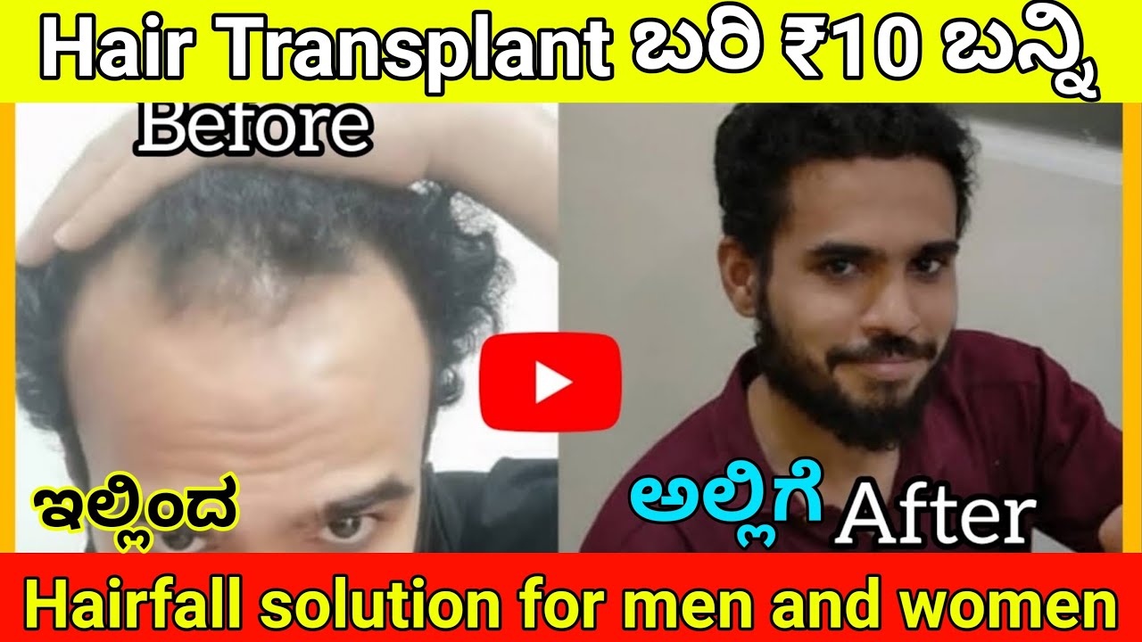 HAIR TRANSPLANT AT 10\- PER GRAFT BEST PRICE IN KARNATAKA || HSN HAIR TRANSPLANT