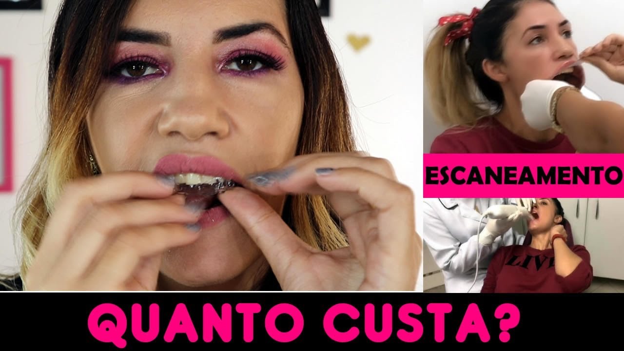 APARELHO INVISÍVEL QUANTO CUSTA? INVISIALIGN NACIONAL ORTHOALIGNER