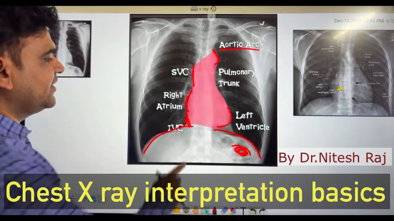 X ray interpretation #drniteshraj