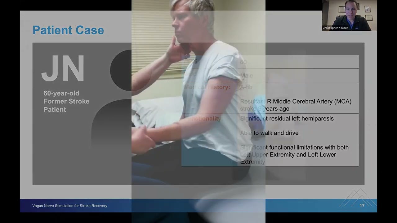 Successfully Improving Weakness After Stroke with Vagus Nerve Stimulation (VNS)