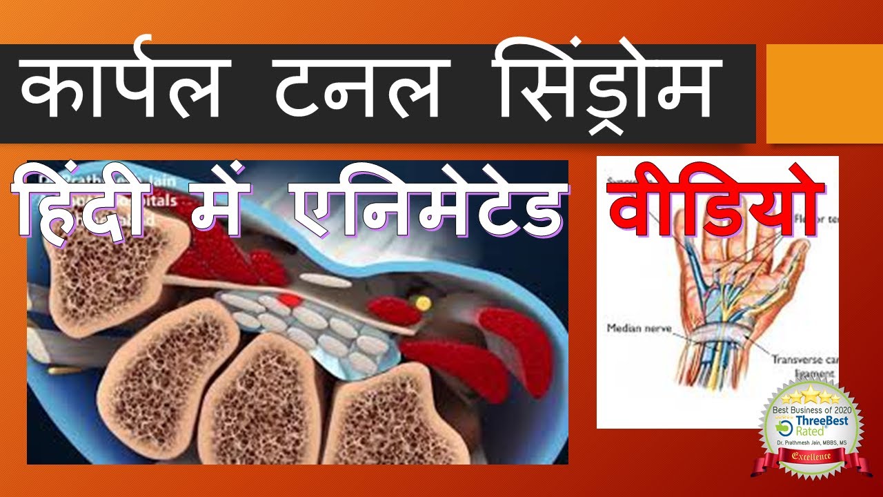 Carpal Tunnel Animated Hindi Carpal Tunnel Syndrome Animated Video in Hindi