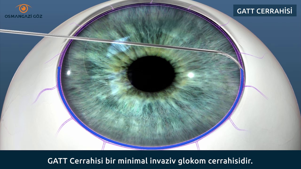 Glokom (Göz Tansiyonu) ve Dikişsiz Glokom Ameliyatı GATT cerrahisi nedir?