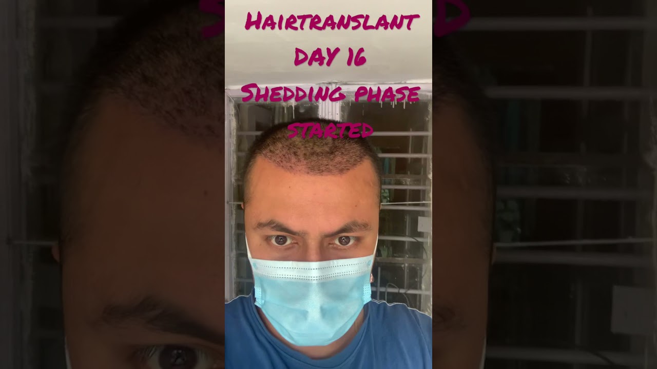 Hairtransplant Day 16- Shedding phase started
