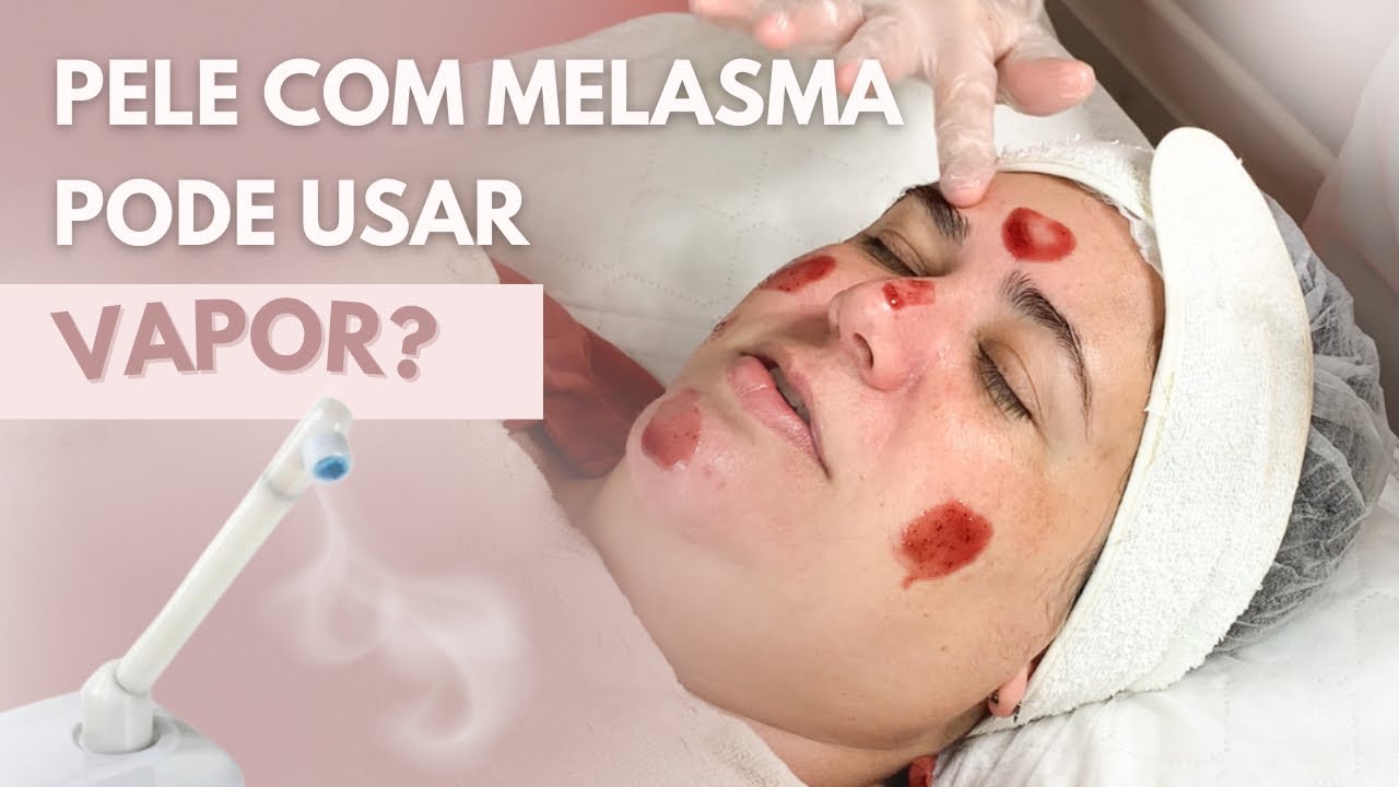 LIMPEZA DE PELE PROFISSIONAL EM PELE COM MELASMA
