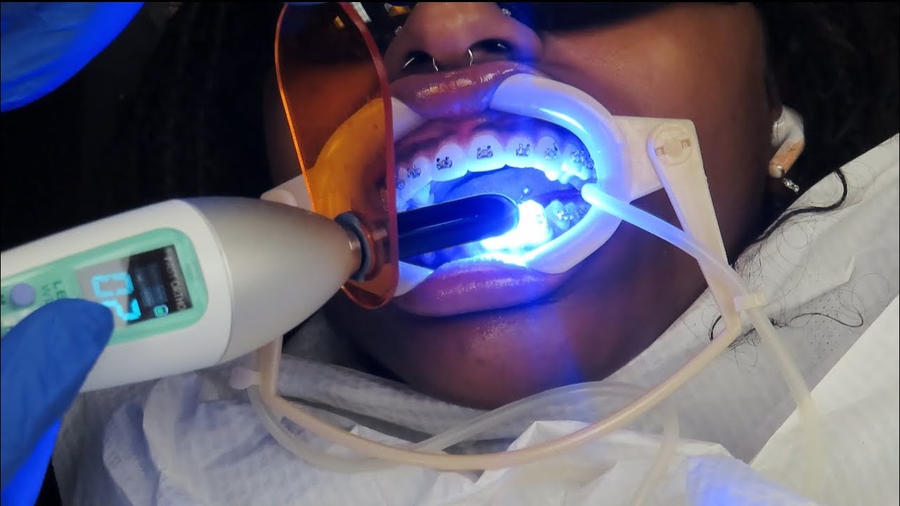 Come with me to get braces… AGAIN