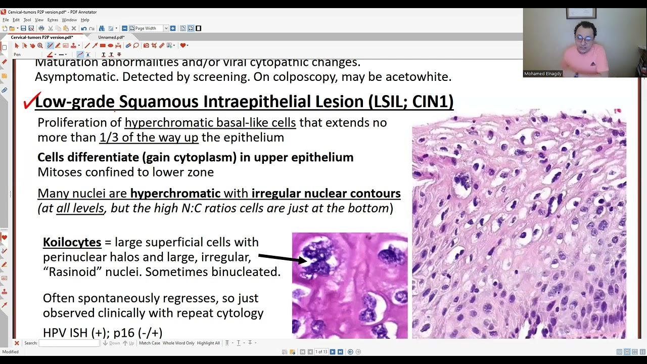 GYN PATHOLOGY: CERVICAL PATHOLOGY