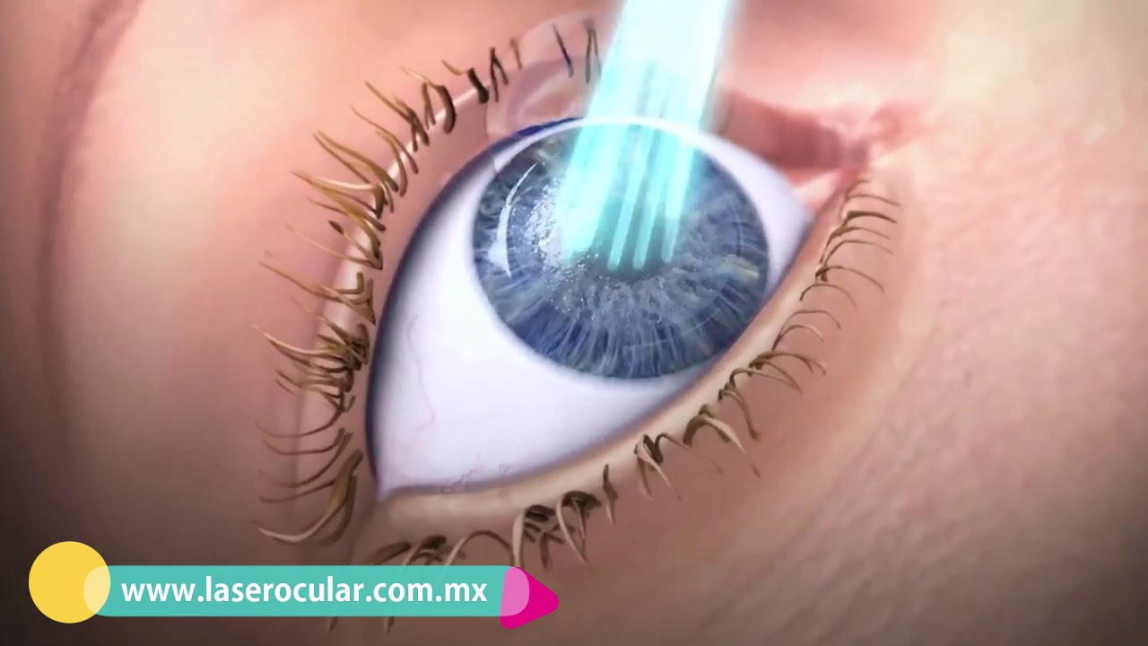 🥇 - Cirugía Láser Excímer | LÁSER OCULAR ® - Clínica de Ojos