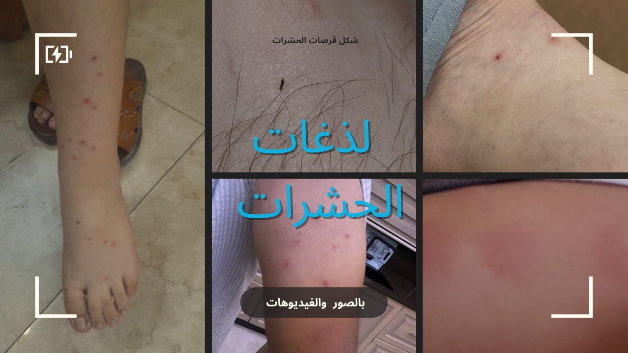 شكل قرصات الحشرات بق الفراش والبراغيث والفاش والناموس والقراد وقمل الرأس