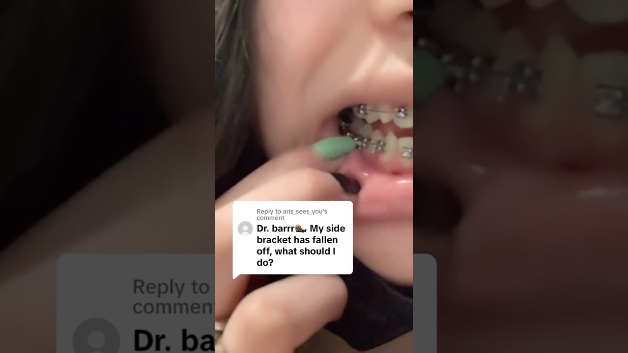 Braces Emergency: What to do for Broken Bracket on the Side