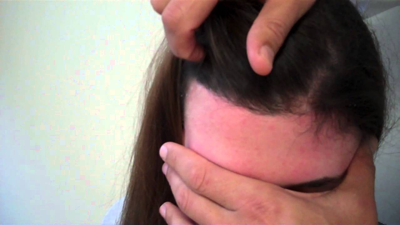 Dr. Epstein - 5 months Post-Op Surgical Hairline Advancement (SHA)