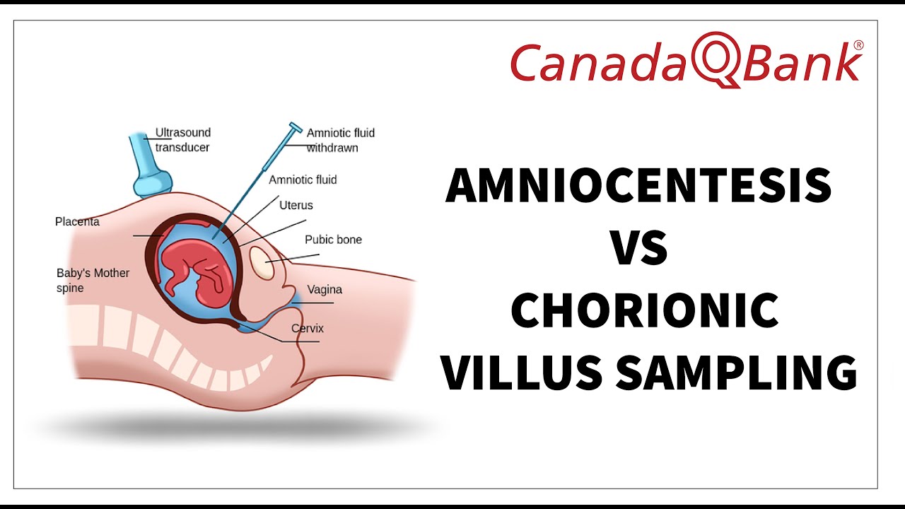 Amniocentesis vs Chorionic Villus Sampling: Key Differences, Indications & Risks | OB/GYN High-Yield