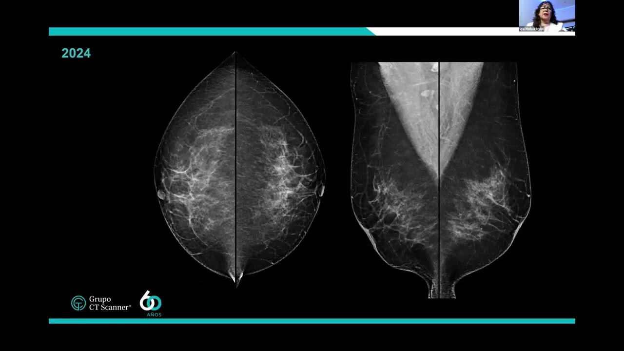 Sesión mensual de la Unidad e Imagen Mamaria, revisión de casos impartidos por CT Scanner México.