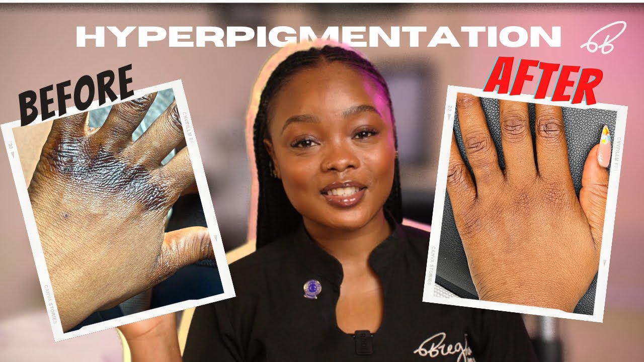 Hyperpigmentation After TSW (Topical Steroid Withdrawal)