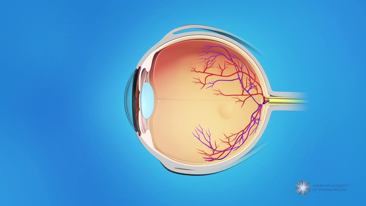 Laser Surgery for ROP