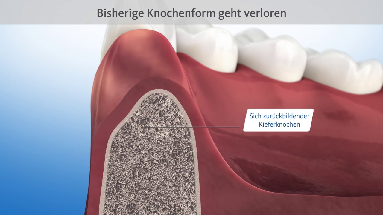 Knochenaufbau nach Zahnverlust (Socket, ridge preservation)