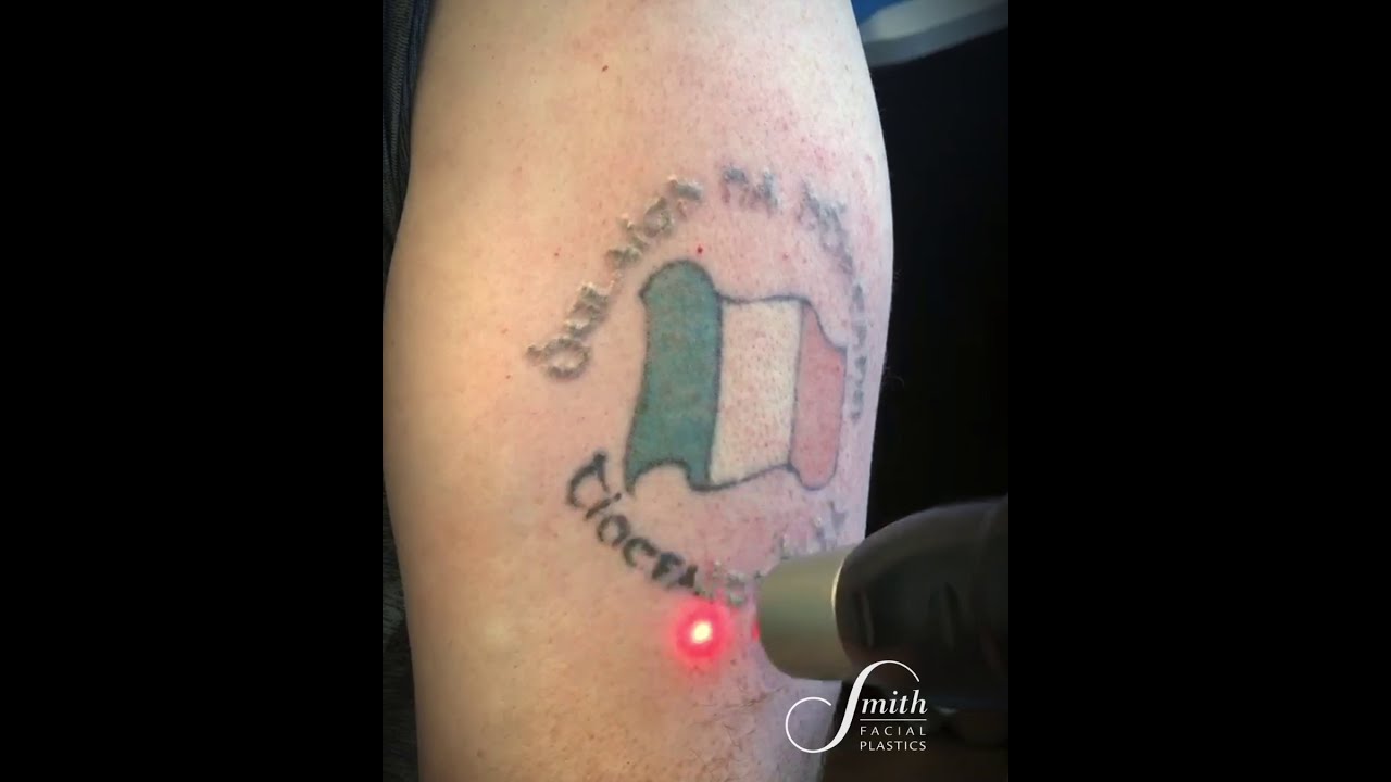 The PicoSure Laser | Laser Tattoo Removal