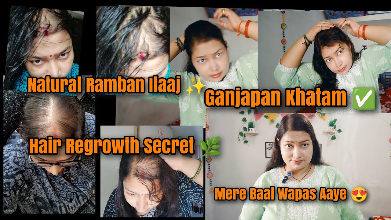 Mere Ganjapan Ka Ramban Ilaaj | Hair Regrowth Natural Tarike Se | Sunshine Shipra
