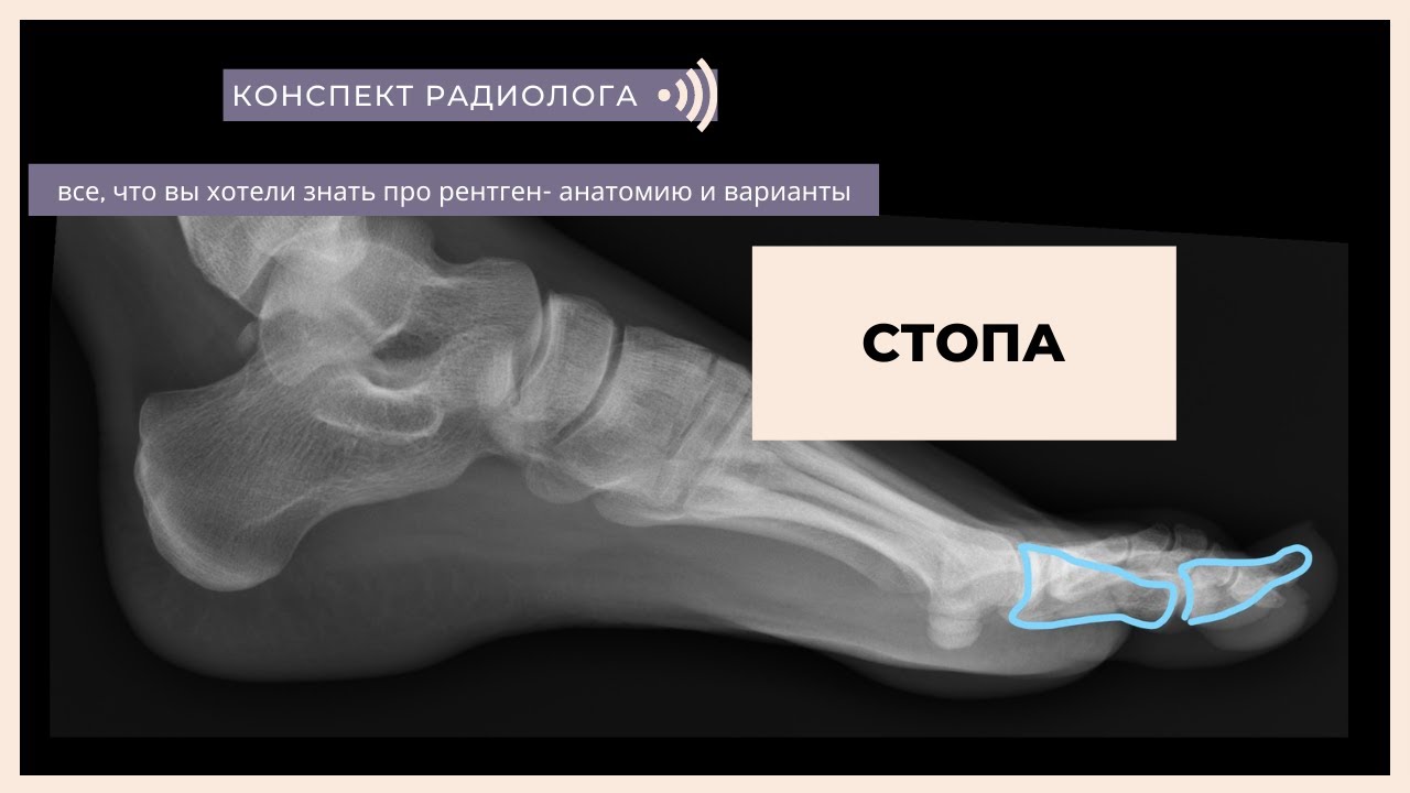 Рентген-анатомия стопы. Теперь вы точно узнаете все про сустав Лисфранка.