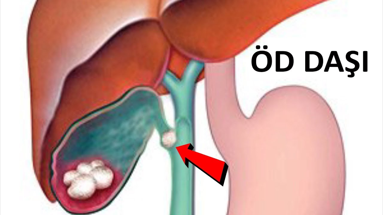 Öd daşı nə vaxt əməliyyat edilməlidir?