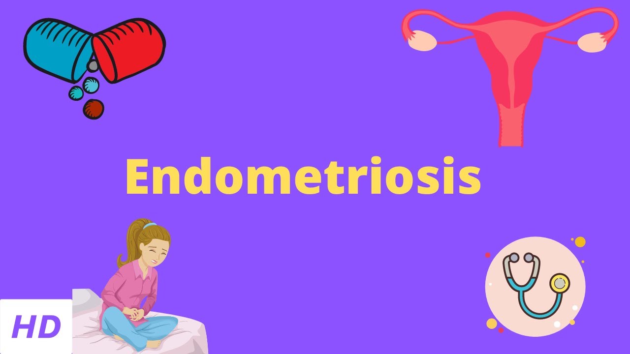 Endometriosis, Causes, Signs and Symptoms, Diagnosis and Treatment.