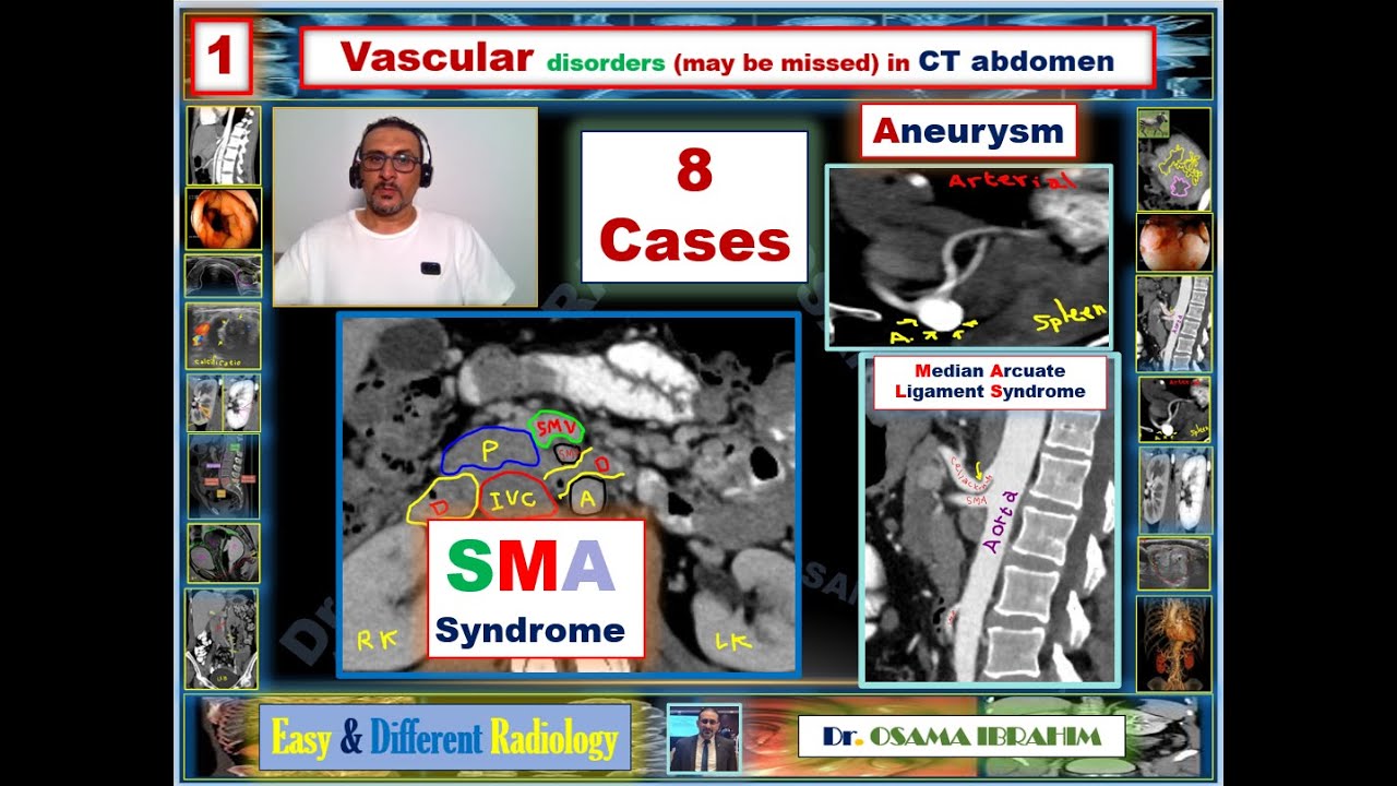 Radiology in GIT : 1- Vascular disorders (may be missed) in CT abdomen