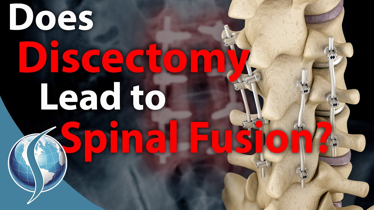 Does Discectomy Lead to Spinal Fusion?