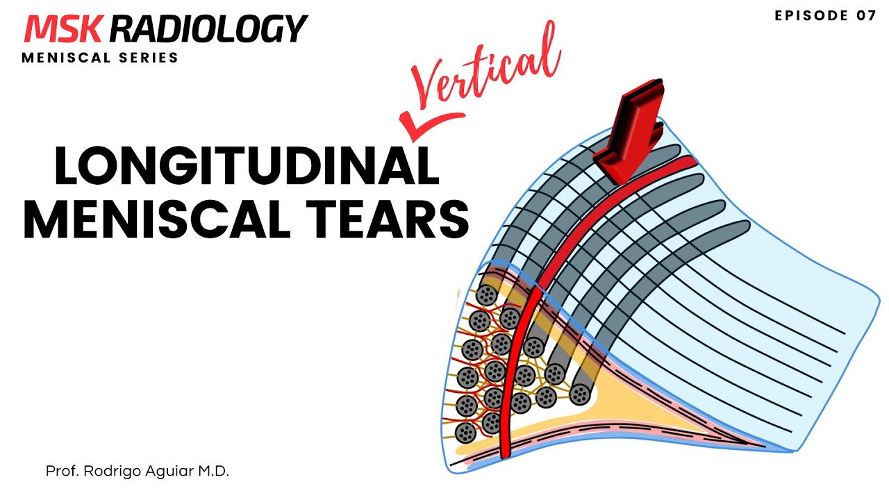 Longitudinal (Vertical) Meniscal Tear on MRI