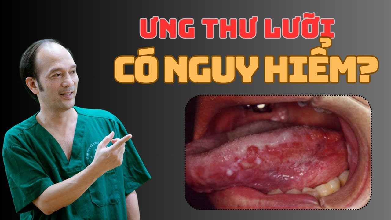 Ung Thư Lưỡi: Nguyên Nhân, Triệu Chứng và Phương Pháp Điều Trị Hiệu Quả - Số 153 | Dr Phùng Khoa