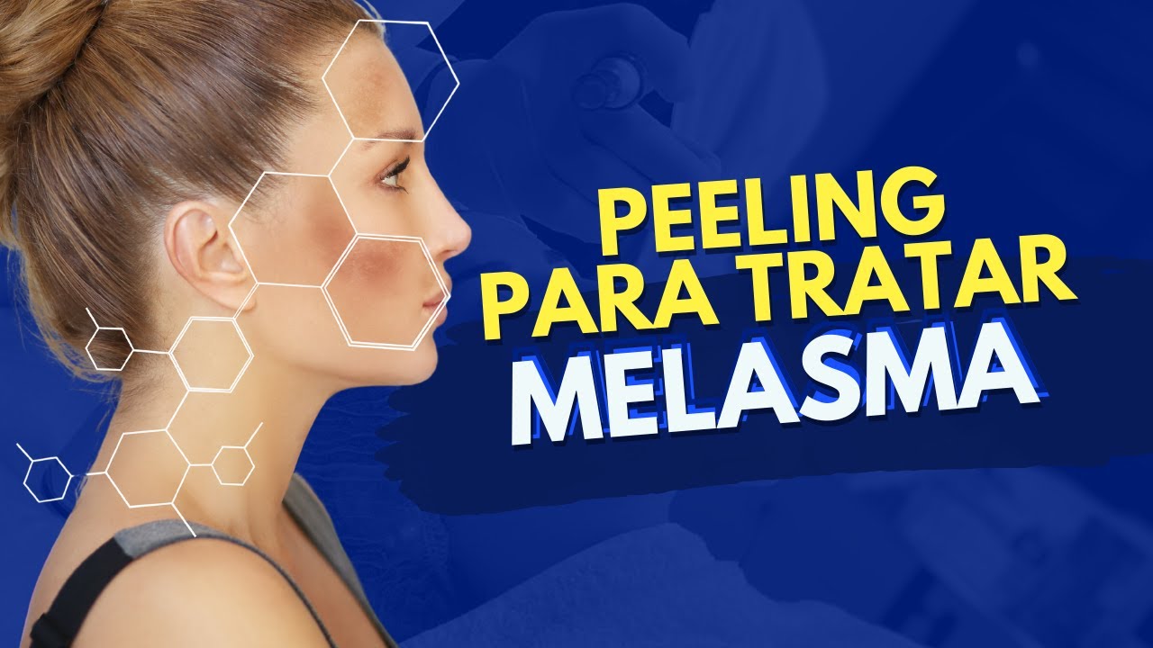 TIPOS DE PEELING PARA MELASMA