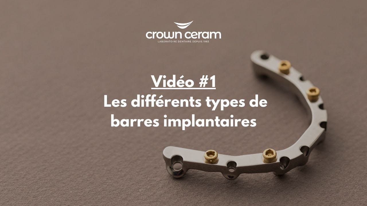 Les barres implantaires : échanges praticien et prothésiste