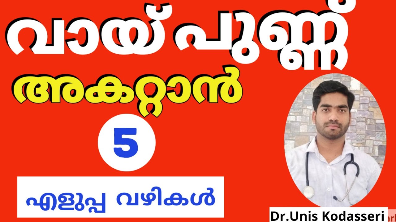 വായ് പുണ്ണ് അകറ്റാൻ 5 എളുപ്പ വഴികൾ|Mouth ulcer Malayalam Home Remedy|Vai punnu|Dr.Unis Kodasseri