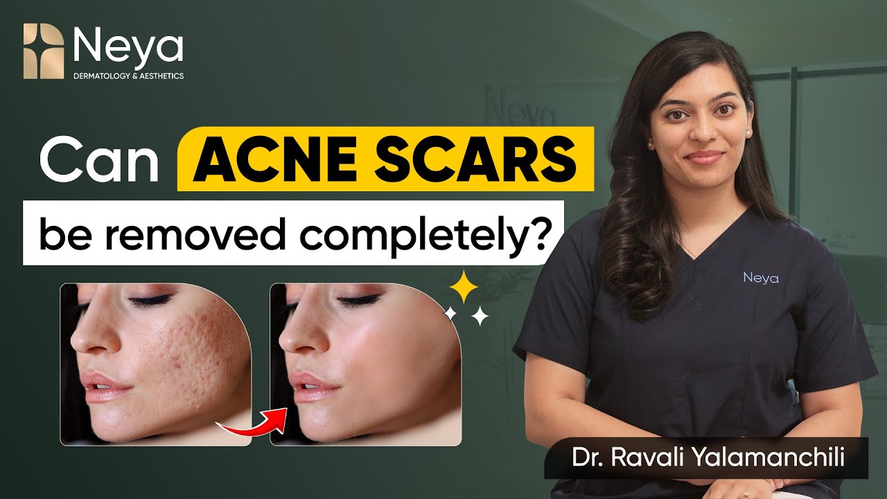 How to get rid of acne scars? | Skin specialist in Hyderabad | Dr. Ravali Yalamanchili