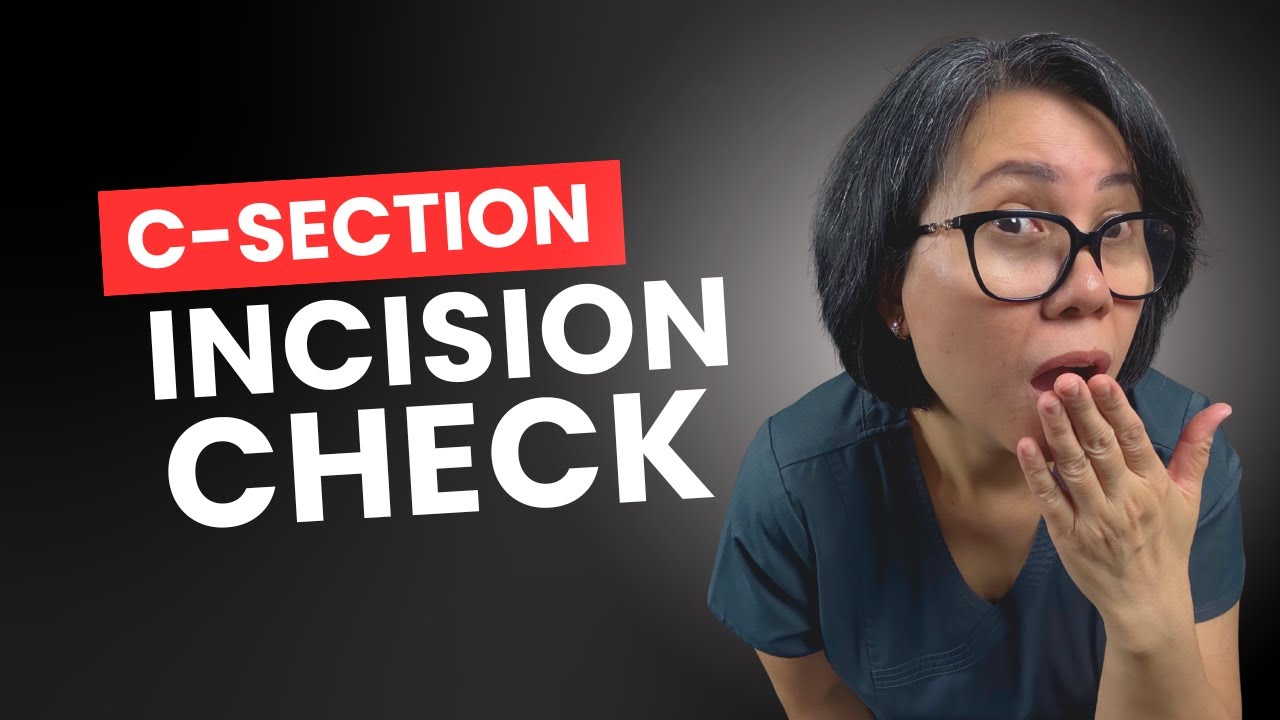 Everything you need to know about c-section incision care