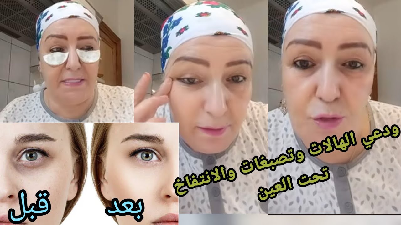 اقوى ماسك لإزالة الهالات السوداء وإنتفاخ تحت العين وحتي تجاعد العين والنتيجة رائعة وفعالة ومضمونة 