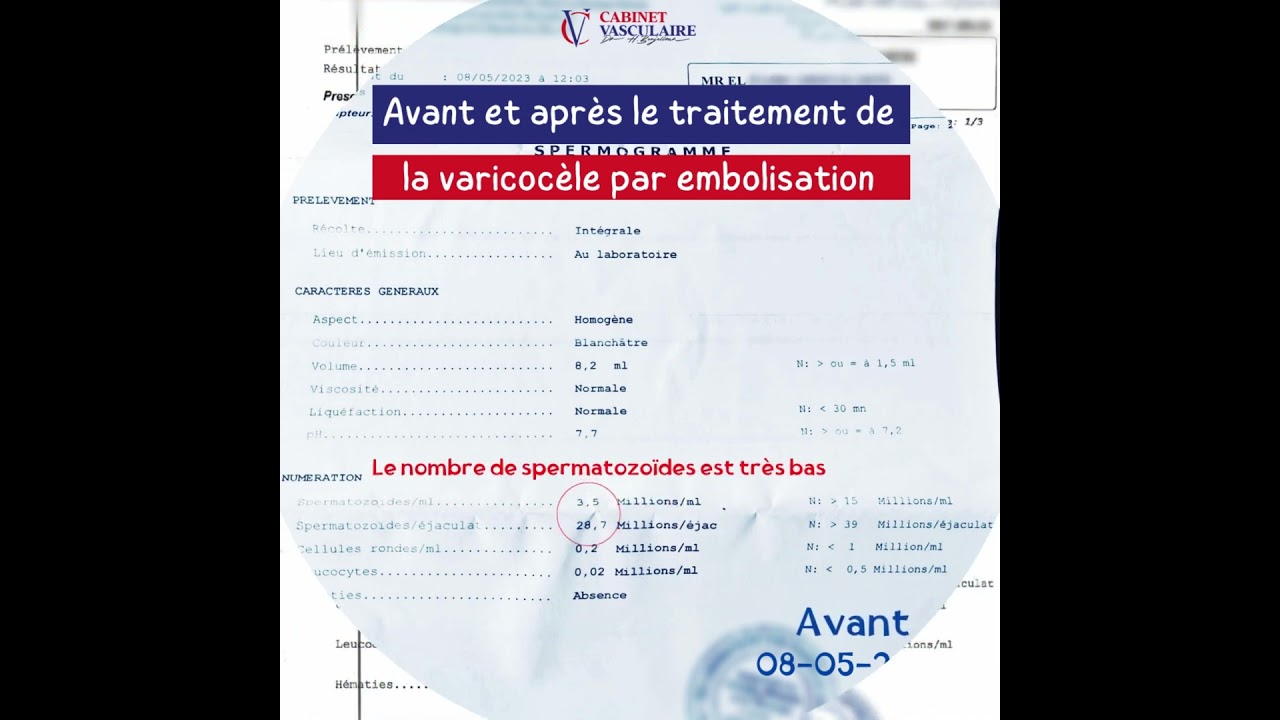 Avant et apr&egrave;s le traitement des varicoc&egrave;les par embolisation